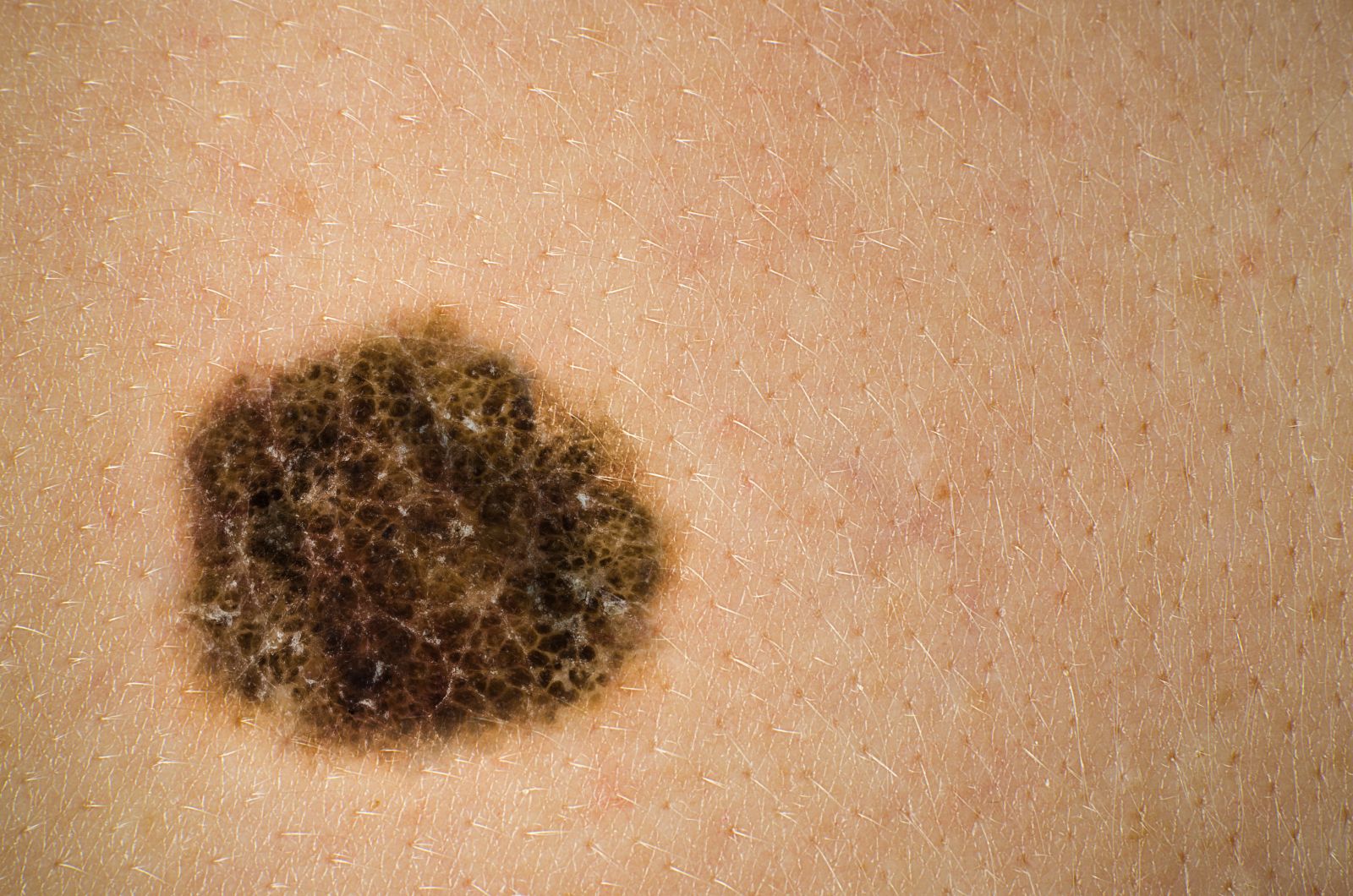 What Are Age Spots Or Liver Spots Elkhart IN Dermatologist